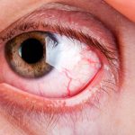Dry Eye Syndrome