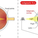 What causes astigmatism to worsen