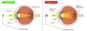 What causes astigmatism to worsen