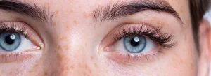 Lazy eye