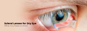 scleral lenses