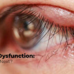 meibomian gland dysfunction