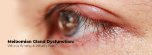 meibomian gland dysfunction